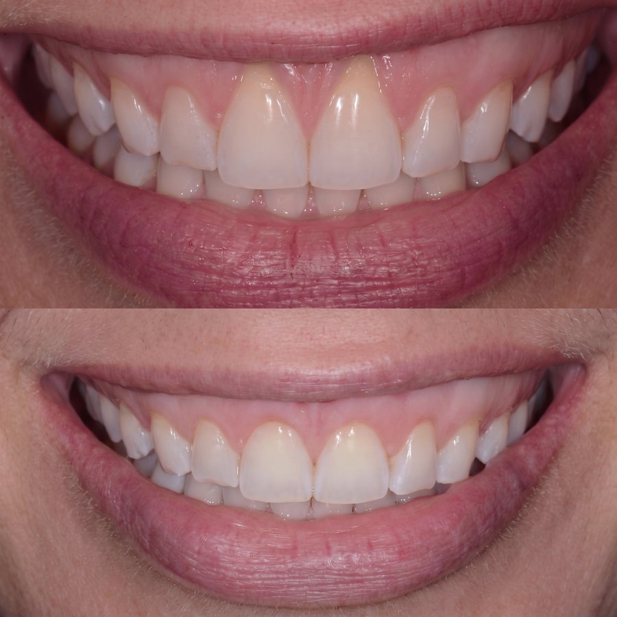 Rétraction : Dents de devant, avant et après. Les gencives ont cessé de se rétracter et adhèrent fermement à chaque dent.