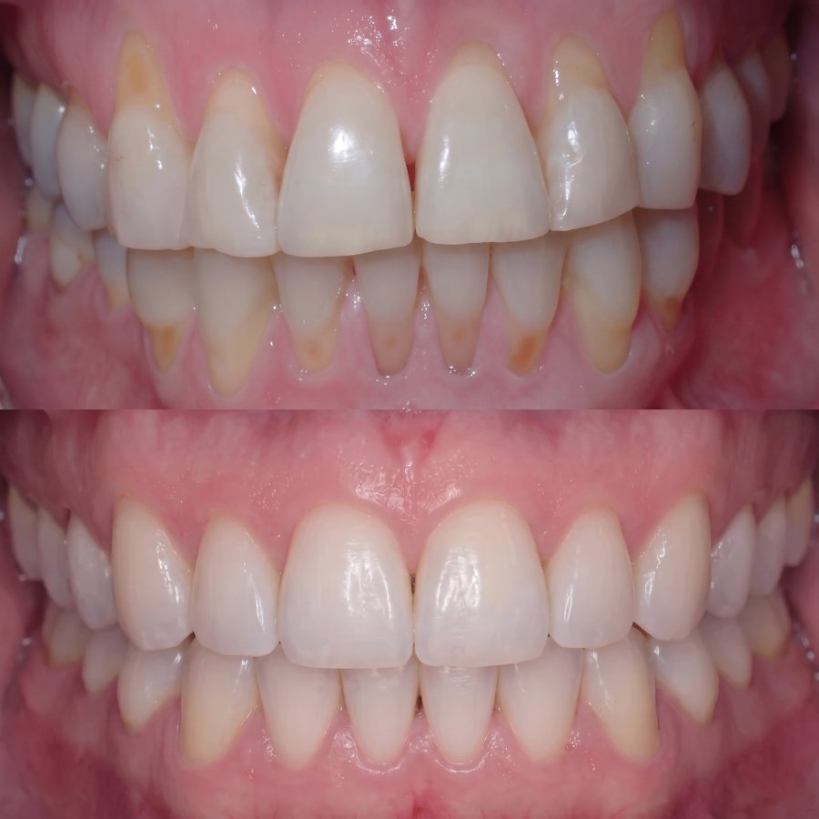 Maladie des gencives : Ligne gingivale inférieure, semaine 1 et semaine 8. Le gonflement rouge foncé a laissé place à un rose sain.